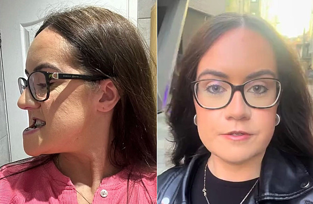 Žena se po letech zbavila vychýlené čelisti. Pomohla jí operace